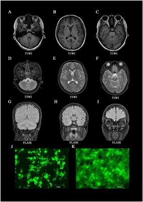 Case report: Orthostatic leg tremor as the initial manifestation in a patient with metabotropic glutamate receptor-5 encephalitis without cortical dysfunction: complexities in identification and treatment